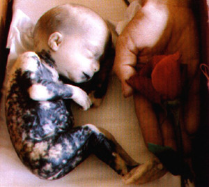 photo for abortion - Photo for abortion.