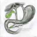 Small Gallstones - A picture of small gallstones. Gall bladder problems, or related, can be excrusiatelingly painful and often misdiagnosed.