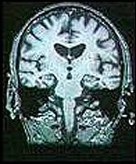 Migraine - Migraine
