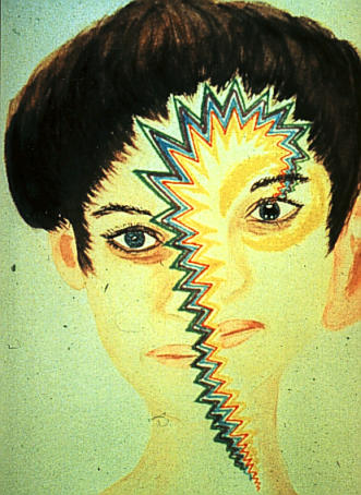 Migraine - Migraine