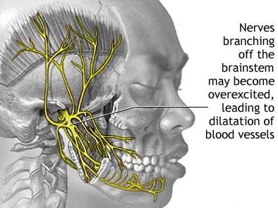 Migraine - Migraine