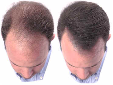 hair loss - hair loss