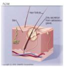tips for loosing acne - tips for loosing acne
