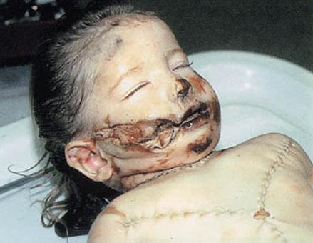 a murdered child - sewn up in the morgue