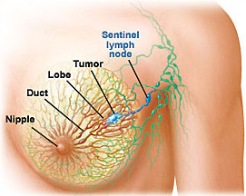 breast cancer - breast cancer is dangerous 