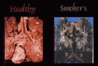 Non-smoker / smokers lung comparison