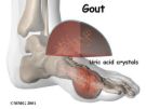 Gout - some people develop this, and like to use more natural remedies