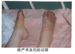 Bad feet - Frostbite can be a terrible thing!