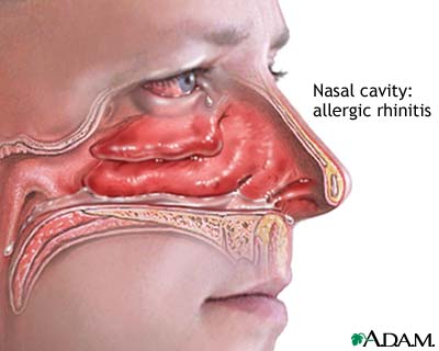 allergic rhinitis - allergic rhinitis detail picture