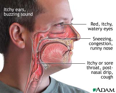 allergic rhinitis - allergic rhinitis detail diagram
