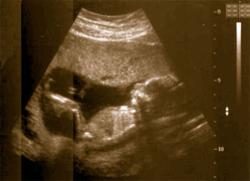 boy or girl - ultra sound. Is it a boy or girl