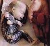 miscarriage - miscarriage
