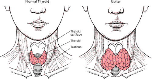 Thyroid Goiter - The term nontoxic goiter refers to enlargement of the thyroid which is not associated with overproduction of thyroid hormone or malignancy. The thyroid can become very large so that it can easily be seen as a mass in the neck. This picture depicts the outline of a normal size thyroid in black and the greatly enlarged goiter in pink. There are a number of factors which may cause the thyroid to become enlarged. A diet deficient in iodine can cause a goiter but this is rarely the cause because of the readily available iodine in our diets. A more common cause of goiter in America is an increase in thyroid stimulating hormone (TSH) in response to a defect in normal hormone synthesis within the thyroid gland. The thyroid stimulating hormone comes from the pituitary and causes the thyroid to enlarge. This enlargement usually takes many years to become manifest.