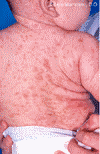 mastocytosis - mastocytosis