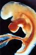 miscarriage - miscarriage