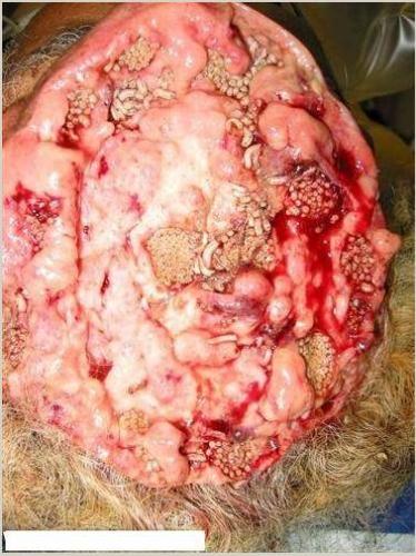 Brain of Mr. Fujiwara - This picture taken before the operation