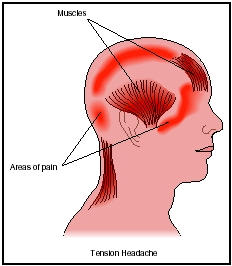 tension headache - Tension headaches are caused by severe muscle contractions triggered by stress or exertion.Tension headaches usually occur in the front of the head,although they may also appear at the top or the back of the skull. 