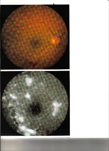 Diabetic retinopathy - See what uncontrolled Diabetes can do to your eyes!!