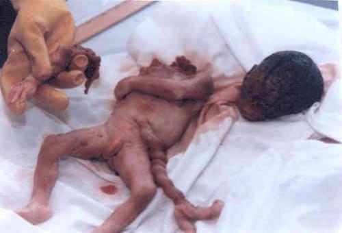 aborted baby http://www.biblia.com/abortion/photos - http://www.biblia.com/abortion/photos.htm