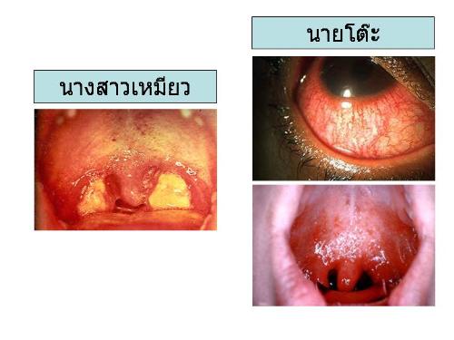 Sore Throat - Picture of the inside of a very sore throat