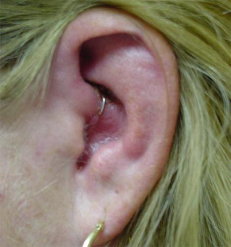 weightloss ear staple - This lady  has celulitis from this ear staple used to lose weight. She didn't lose weight just gained an infection.
